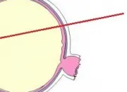 Quiz Bac de sciences 1re L/ES : l'oeil et la vision (SVT)